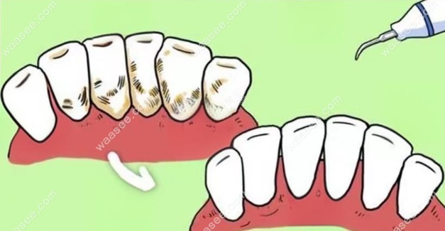 全口牙周炎治疗手术手术