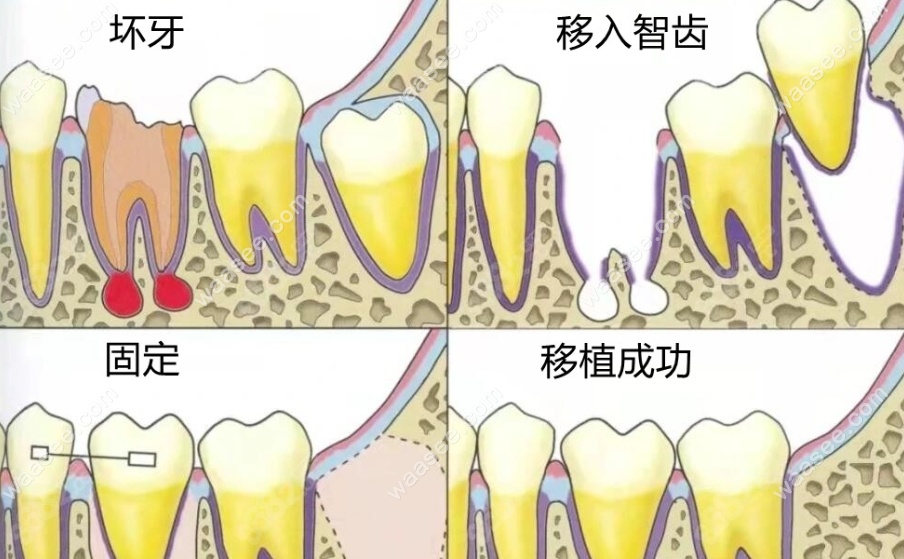 自体牙移植技术www.waasee.com