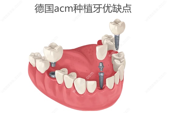 德国acm种植牙优缺点www.waasee.com