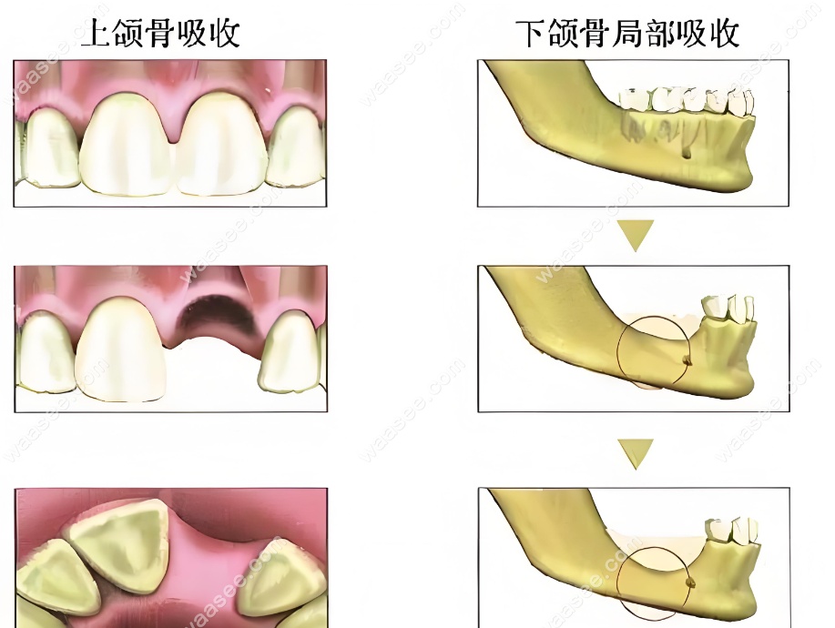 牙槽骨吸收