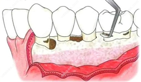 牙槽骨萎缩牙齿松动加骨粉可以固定牙吗?可以但不能全固定