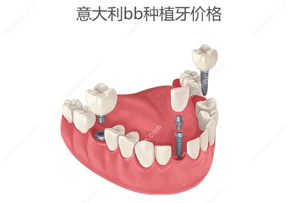 意大利bb种植牙价格
