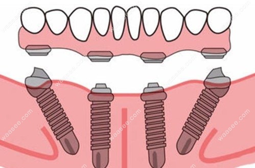 种植牙种4颗和6颗的区别:4颗便宜,骨质不好可选6颗更稳定