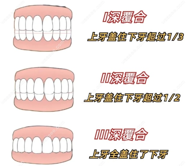 深覆合