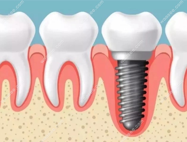 种植牙是不是越贵越好?种植牙贵的和便宜的质量区别在这