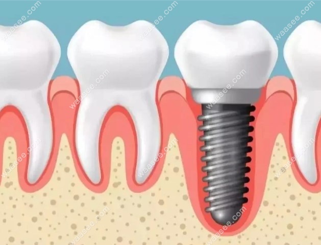 种植牙与自己牙有什么区别?详细解析两者间的六大核心差异