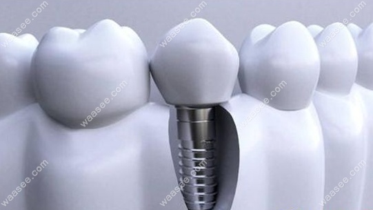 你知道诺贝尔种牙的三个型号的区别吗?它们分别在设计/材质