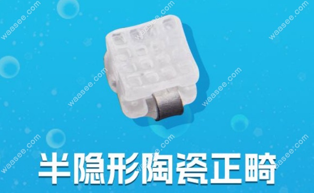半隐形陶瓷矫正器