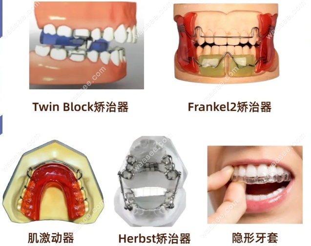 孩子下颌骨后缩矫正方式
