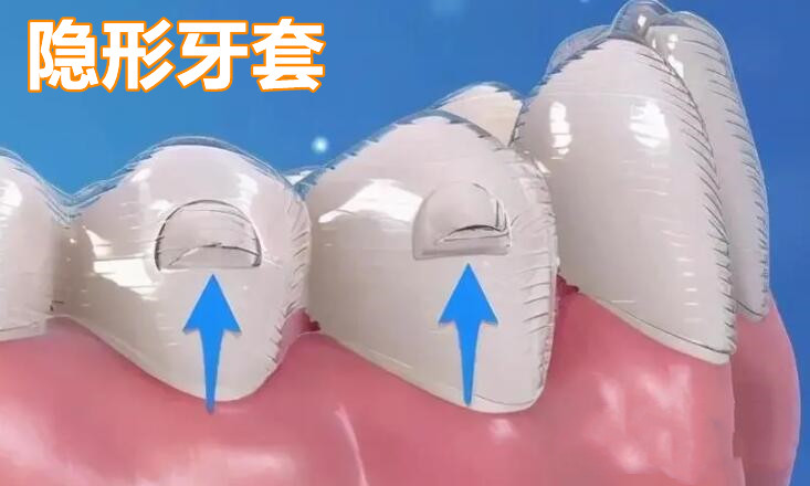 隐形牙套
