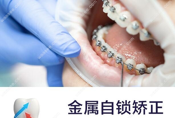 重庆乐迪口腔金属矫正项目