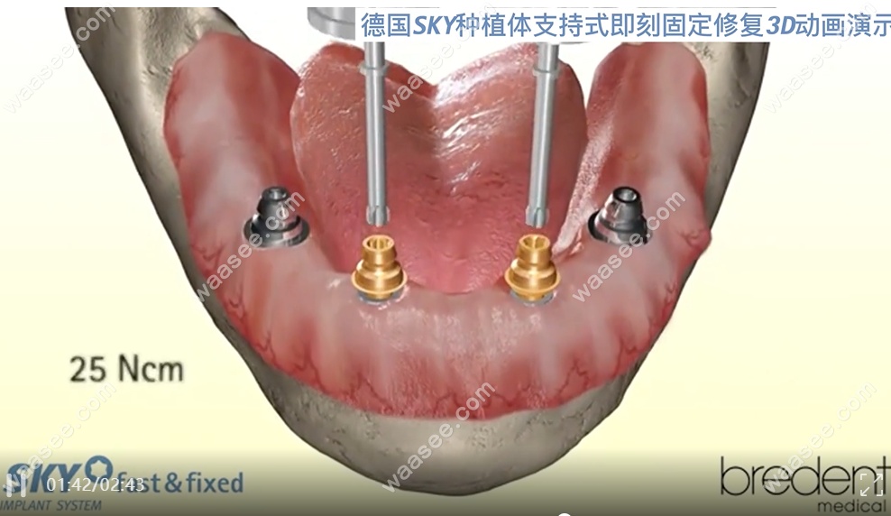 德国sky种植体即刻修复图片