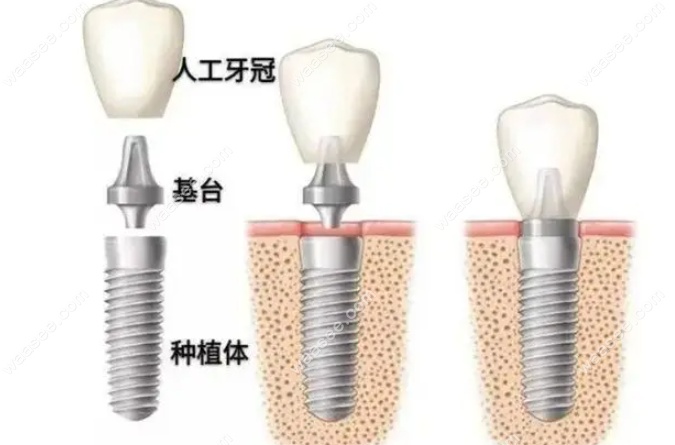 深圳齐尔美口腔种植牙项目
