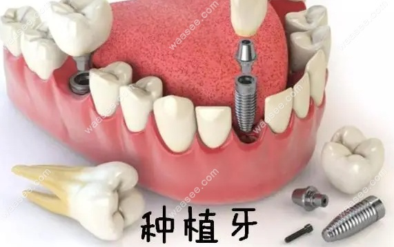熊巍医生擅长牙齿缺失的种植与修复技术