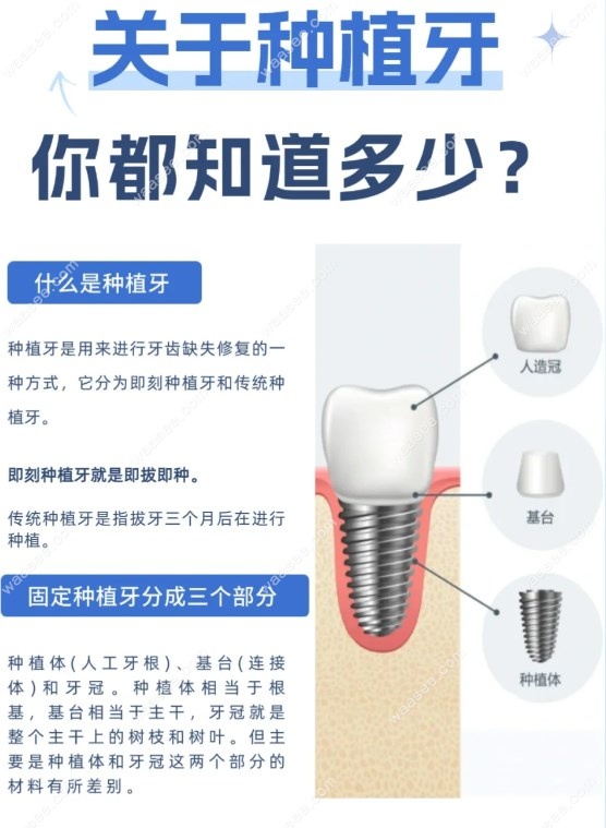 什么是种植牙