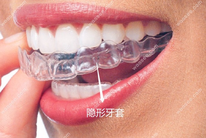 丽速齐隐形牙套www.waasee.com