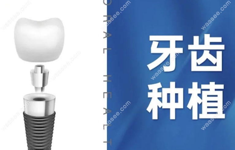 孙连超医生种牙病例高达2万颗