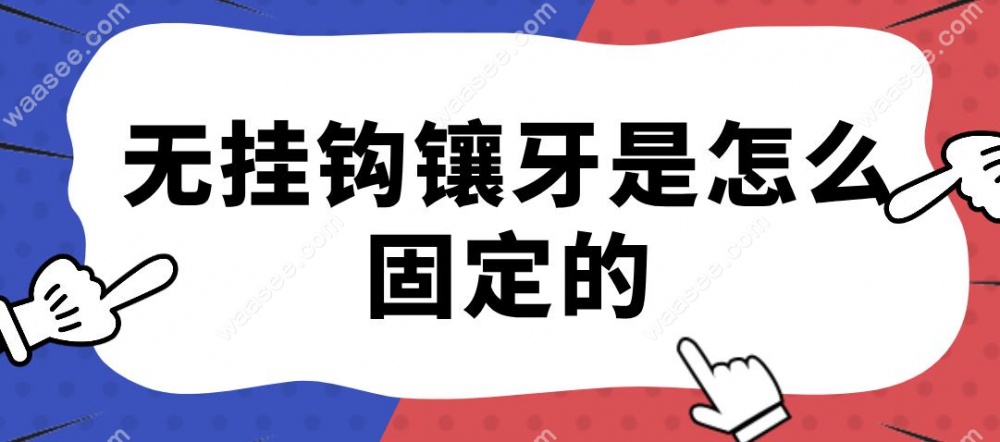 无挂钩镶牙是怎么固定的