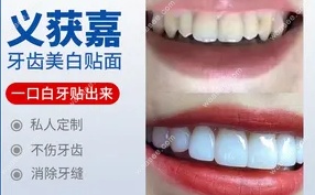 义获嘉全瓷贴面可用于前牙美学区的牙齿美白修复