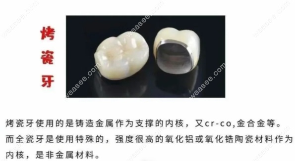 根管治疗烤瓷牙套价格表