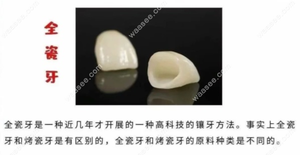 2024-2025年根管治疗全瓷牙套价格表