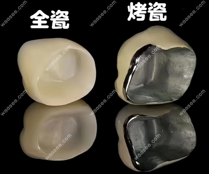 根管治疗烤瓷+全瓷牙套对比