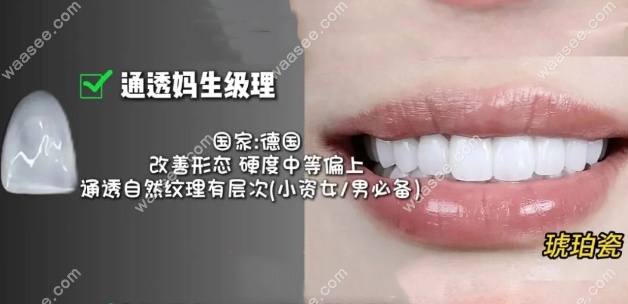 琥珀瓷贴面怎么样？高端档次