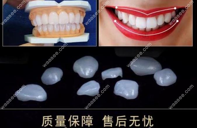 琥珀瓷牙贴面的优缺点
