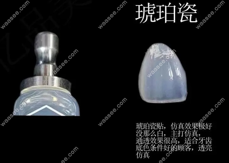 琥珀瓷贴面怎么样？琥珀瓷贴面属于高端档次