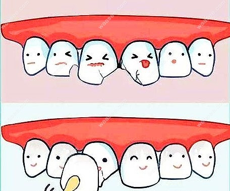 牙贴面品牌价格