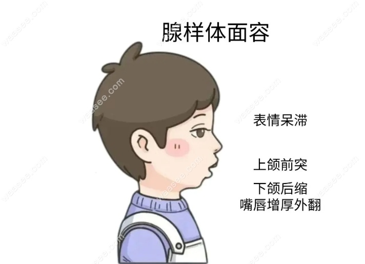 儿童腺样体面容图片