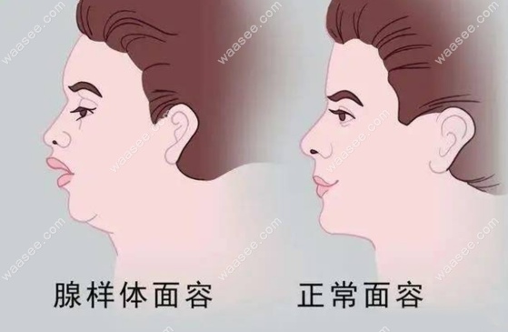 儿童腺样体面容图片和正常图