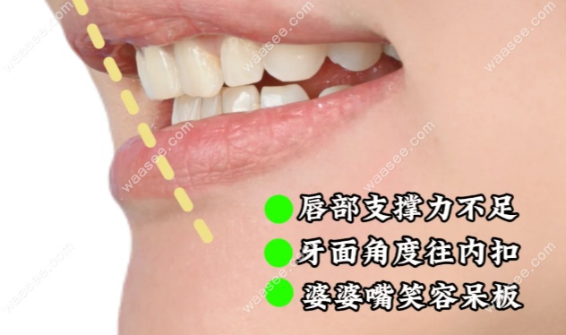 牙齿内扣