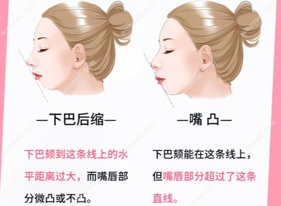 嘴凸下巴后缩矫正