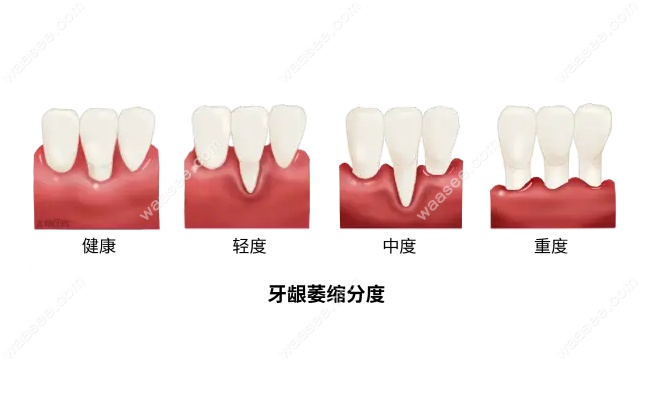 牙龈萎缩多少钱能治好？