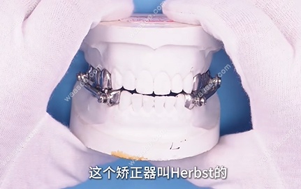 孩子戴herbst矫正器怎么样