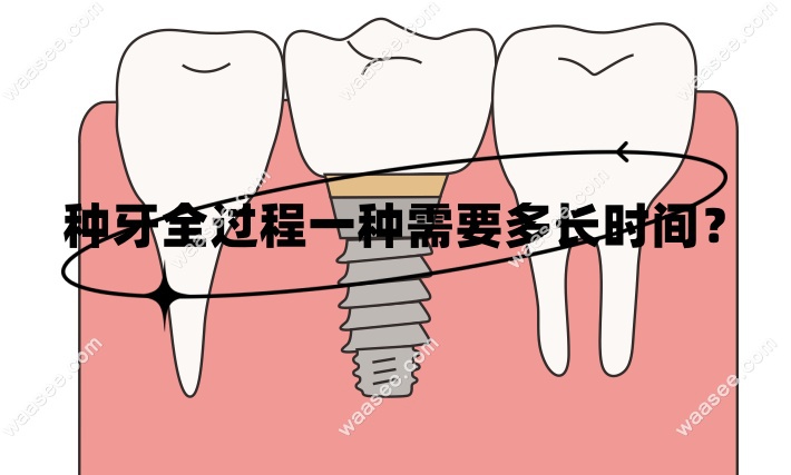 种牙全过程一种需要多长时间www.waasee.com