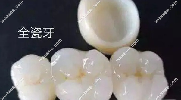 全瓷牙冠示意图