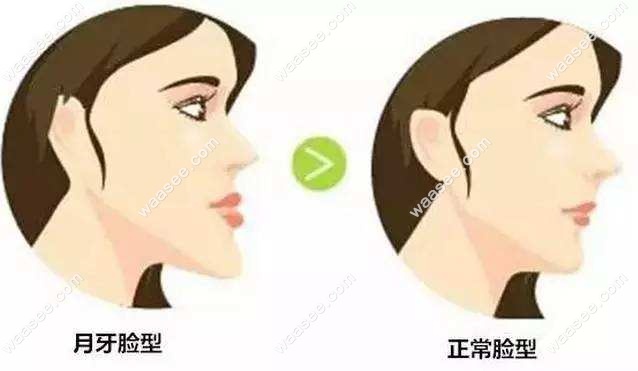 牙齿畸形影响颜值