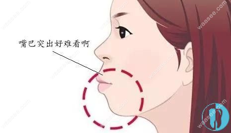 嘴巴突出侧脸好难看