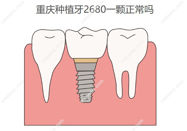 重庆种植牙2680一颗正常吗www.waasee.com