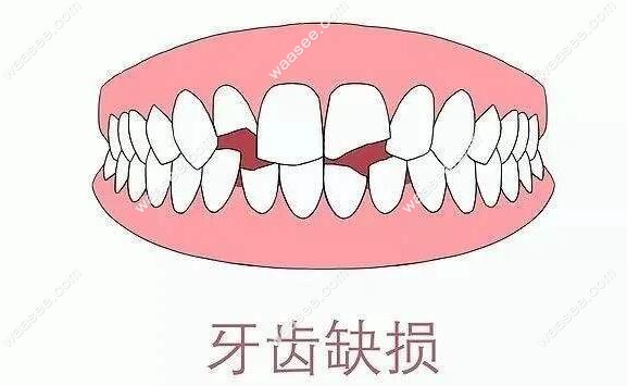 前牙缺损的美容冠修复