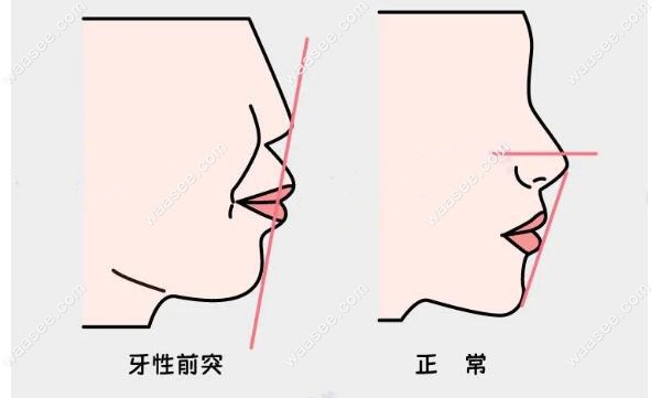 骨性和牙性嘴凸区分方法