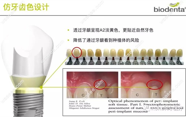Biodenta种植体的颈部设计优势