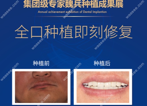 重庆泰康拜博口腔魏兵种植牙
