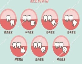 不同智齿的生长位置
