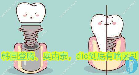 韩国登腾奥齿泰dio种植体的区别