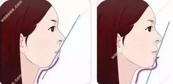 假性凸嘴的症状图