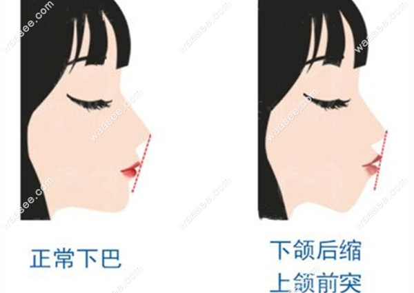 正常面型和凸嘴下巴后缩对比