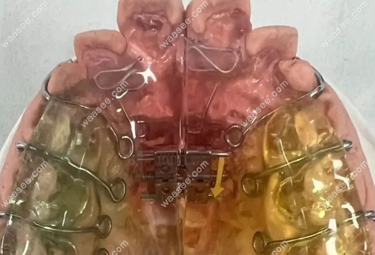 扩弓器矫正牙齿多少钱？